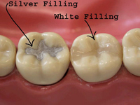 dental bonding or filling toronto markham