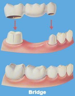 dental bridges Toronto Markham 3