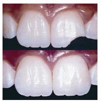 dental crowns Toronto Markham 5