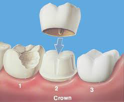 dental crowns Toronto Markham 1