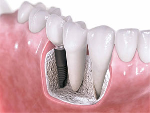 dental implants Toronto Markham 1