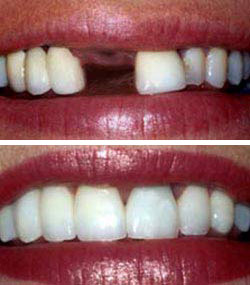 dental implants Toronto Markham 2