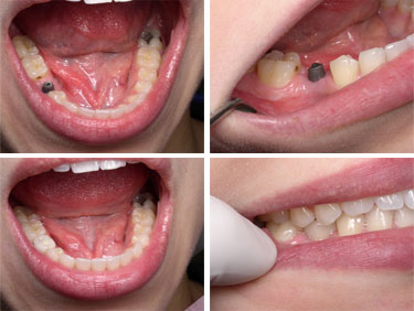 dental implants Toronto Markham 3