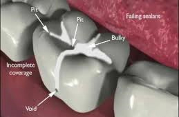 dental sealant toronto markham