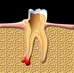 root canal therapy Toronto Markham 1