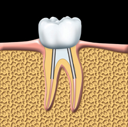 root canal Toronto Markham 2 - Root Canal Markham