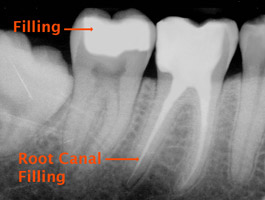 root canal Toronto Markham 3 - Root Canal Markham