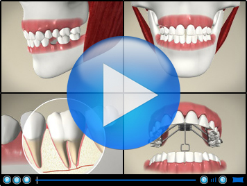 video of dental cleaning method of flossing toronto markham